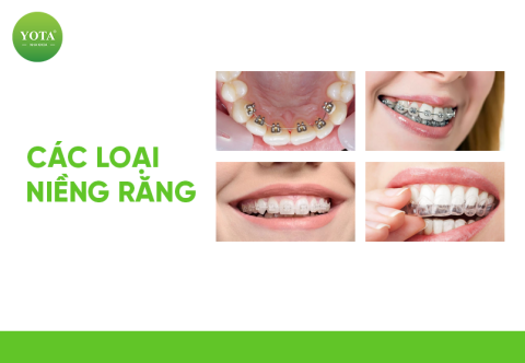 Các Loại Niềng Răng Tốt Phổ Biến Nhất Năm 2025